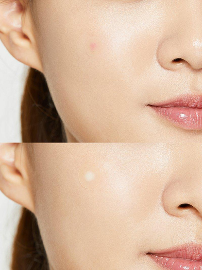 Acne Pimple Master Patch 24 patches